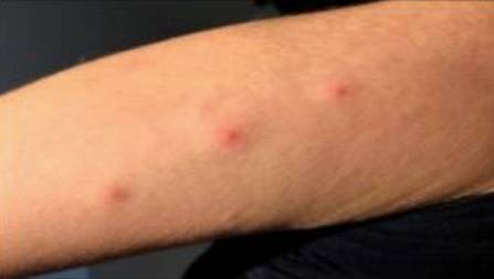 빈대에 물린 자국은 모기에 물렸을 때와 비슷하지만, 자국이 일렬로 나타난다는 게 특징이다. 질병관리청