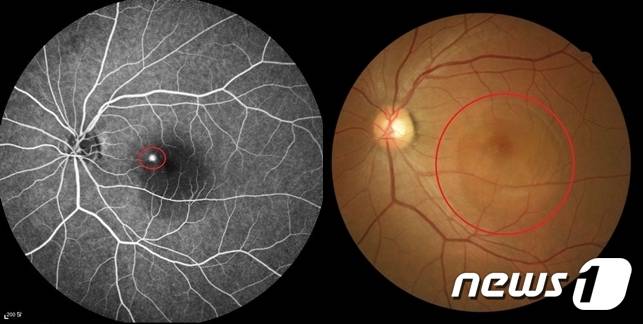 중심장액성 맥락망막병증으로 누출점이 보이는 형광안저조영술 사진(왼쪽), 황반부 염증으로 인해 망막 아래에 물이 고여 있는 모습의 안저사진/(김안과병원 제공)