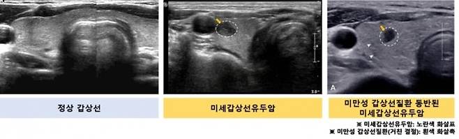 갑상선 초음파 장면. 사진 왼쪽부터 정상 갑상선, 미세 갑상선 유두암, 미만성 갑상선 질환이 동반된 미세 갑상선 유두암./사진=서울대병원