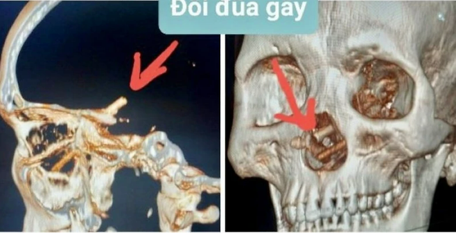 코를 뚫고 두개골에 박힌 젓가락 한쌍. / 사진=뚜오이째