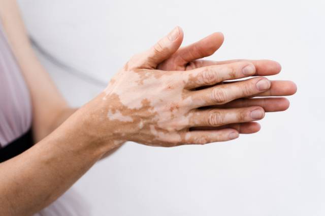 손등과 손가락에 병변이 발생한 백반증 환자. 사진 제공=서울대병원
