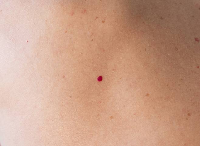 노화로 생기는 체리혈관종은 몸에 문제를 일으키지 않아 제거하지 않아도 된다./사진=게티이미지뱅크