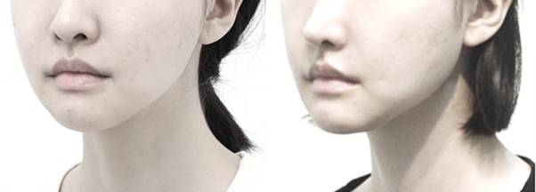 귀밑각(하악각)이 원인이 아니므로, 본시멘트를 넣어 각을 되살린다고 해서 얼굴 모습이 좋아지지 않는다.