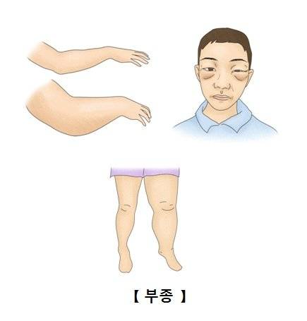 부종 관련 이미지. 사진 서울아산병원