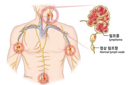 림프종과 정상 림프절. 국립암센터
