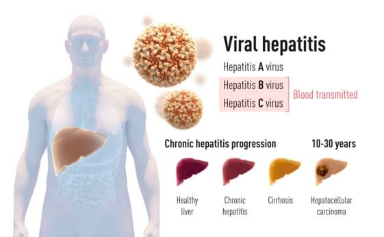 간염에는 두가지 형태가 있다. 오염된 물이나 음식으로 전염되는 A형 간염 바이러스에 의한 급성 질환이 있고, B형 간염 바이러스 또는 C형 간염 바이러스에 의해서도 발생한다. 혈액 매개 간염은 종종 간경변과 간암으로 진행될 수 있는 만성 질환이다. /조선DB
