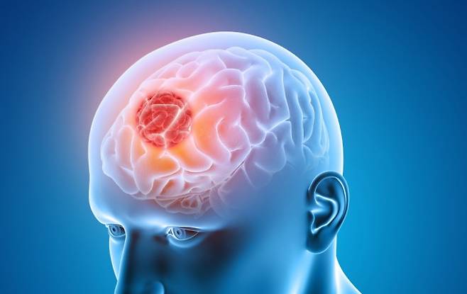 뇌종양 환자의 70%는 두통 증상이 나타난다. kirstypargeter/게티이미지뱅크 제공.