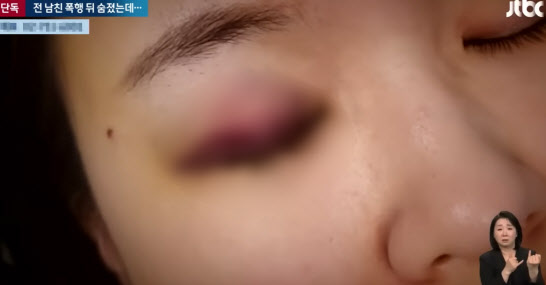 전 남자친구에게 폭행을 당해 입원 치료를 받다 숨진 여성의 멍든 눈 (사진=JTBC 뉴스룸 방송 캡처)