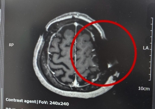 동그라미 부근의 머리뼈에 쇠톱 날이 박혀 자기공명영상(MRI)이 제대로 찍히지 않았다. MRI는 자기공명을 이용하는데 금속 물질이 있어 정상적으로 작동하지 않았다고 한다. [사진 = B씨 제공, 연합뉴스]