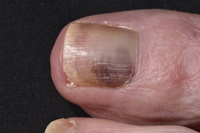 원인 모를 손발톱 멍이 2주 이상 지속된다면 정확한 진단을 받아보는 게 좋다./사진=클립아트코리아