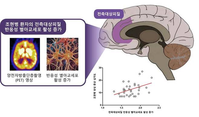 조현병 환자의 뇌 속 전측대상피질에서 반응성 별아교세포(뇌 염증 반응 및 글루타메이트 조절 이상 시사)의 활성 증가를 확인했다. 또한, 조현병 환자에서 전측대상피질의 반응성 별아교세포 활성이 증가할수록 환청, 망상 등 조현병의 양성 증상이 심각하다는 것을 확인했다.
