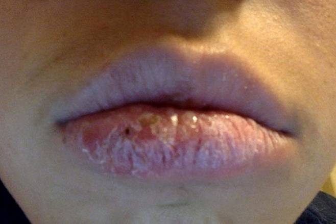 선크림을 입술에 바르지 않으면 광선 구순염이 생길 수 있어 주의해야 한다./사진=Current Dermatology Reports