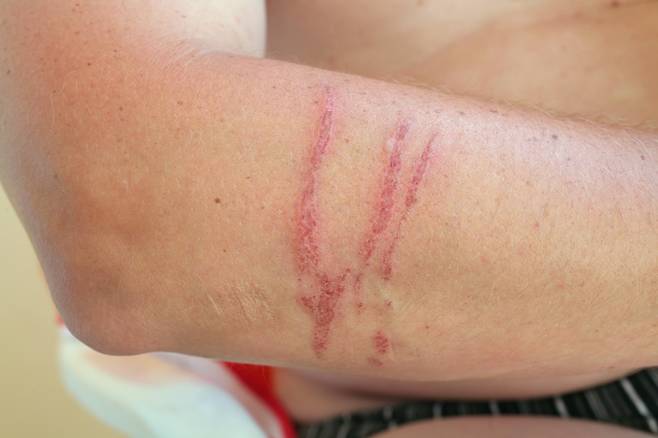 해파리에 쏘였다면 바닷물이나 식염수를 이용해 씻어낸 뒤 침을 제거해야 한다./사진=클립아트코리아