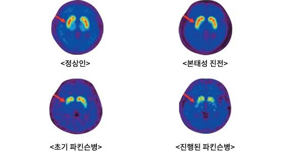 듀켐바이오의 파킨슨병 진단용 방사성의약품 'FP-CIT'으로 뇌의 기능을 이미지화 한 모습. /이미지=듀켐바이오 홈페이지