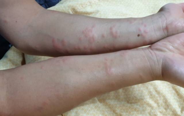 국내 해수욕장에서 바다 물벼룩으로 의심되는 생물에 쏘여 부어오른 모습. 독자제공