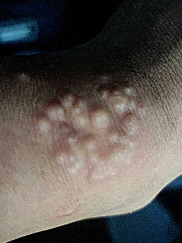 바다 물벼룩에 쏘여서 부풀어오른 피부. 독자제공