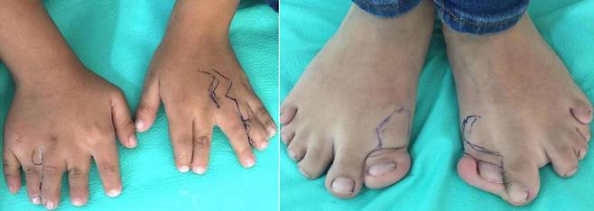 멕시코 6세 남아가 다지증, 합지증 증상으로 병원을 찾았다./사진=국제외과저널사례보고