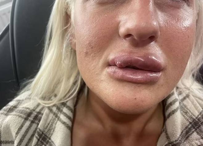 10년간 주기적으로 입술 필러를 맞은 영국인 니콜 맥마너스(30)가 입술이 괴사되는 부작용을 겪었다고 고백했다./사진=데일리메일 캡처