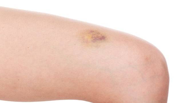 보기 싫은 멍, 올바른 방법으로 관리하면 빠르게 제거할 수 있다|출처: 게티이미지뱅크