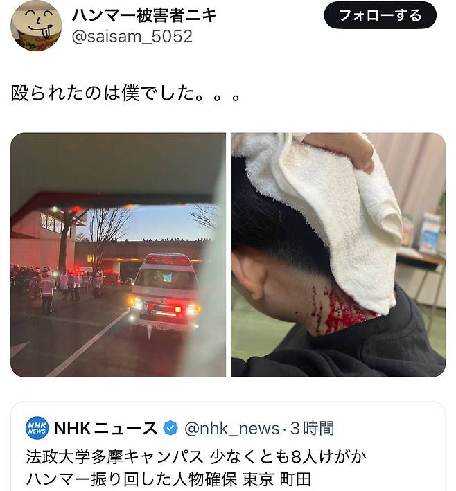 123.jpg 일본대학에서 한국여대생 망치난동 피해 학생 사진 ㄷㄷㄷ