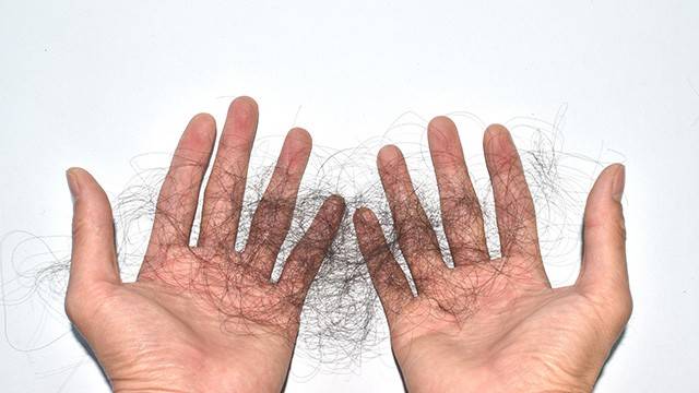 탈모의 종류로는 남성형 탈모, 원형 탈모, 휴지기 탈모, 외상성 탈모, 화학적 탈모 등이 있다|출처: 클립아트코리아