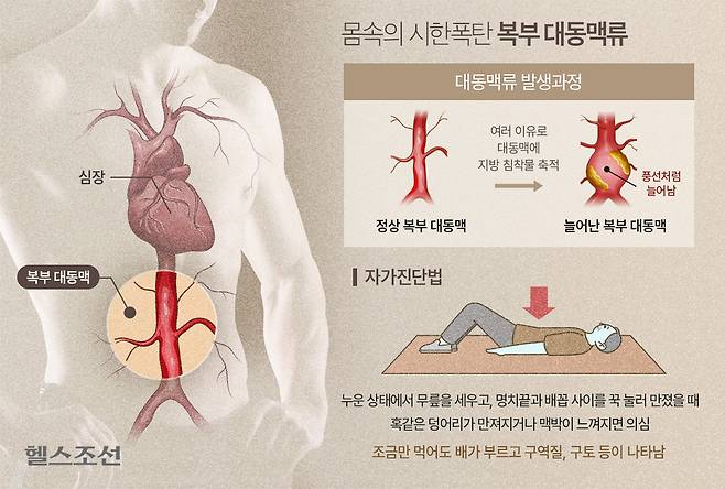 배 속에서 두근두근, 쿵쿵대는 느낌을 주는 덩어리가 만져진다면 '복부 대동맥류'를 의심해봐야 한다./그래픽=김남희