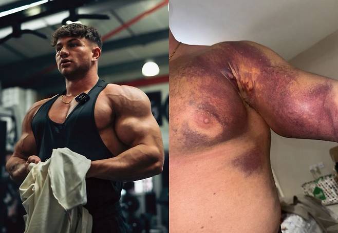 트리스탄 반스(23)는 18세부터 보디빌더가 되고 싶어 스테로이드를 사용했는데, 최근 과도한 운동 중 가슴 근육이 파열됐다./사진=더 선