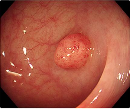 대장 용종 가운데 암으로 진행할 가능성이 가장 큰 선종./사진=질병관리청