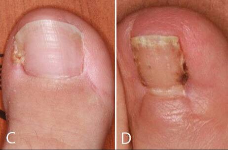 (C)연부조직 절제술을 받은 발톱 (D)발톱 절제술을 받은 발톱의 모습. 연부조직 절제술을 받은 발톱이 발톱 절제술을 받은 사례와 비교해 회복 후 발톱의 폭이 크게 개선되는 모습을 보였다.