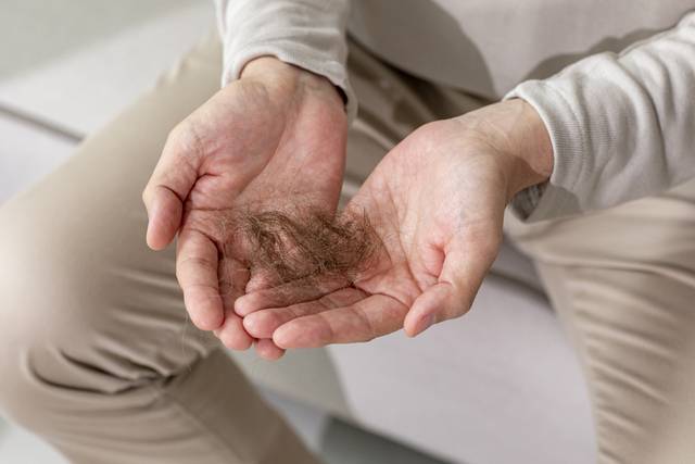 탈모 예방 등에 도움이 된다고 알려진 맥주효모와 비오틴을 함유한 식품이 실제로는 모발 건강과 관련한 기능성이 인정되지 않았고, 과학적 근거도 없는 것으로 드러났다. 사진은 기사의 특정 사실과 관련 없음. 이미지투데이