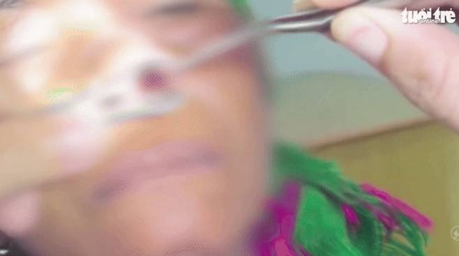 베트남 한 여성의 코에서 6cm가 넘는 거머리가 발견돼 보는 이들을 경악하게 했다./사진=Nguoi Dua Tin, 뉴시스