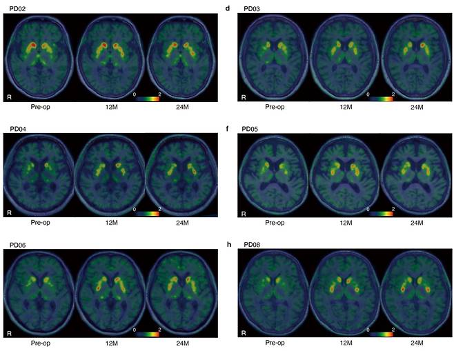 파킨슨병 환자에게 유도만능줄기세포로 만든 도파민 신경전구세포를 투여했다. 24개월 추적 관찰한 결과 별다른 부작용이 발생하지 않았다. 파킨슨병 증상 완화에 도움이 되는 것으로 나타났다. /네이처