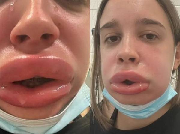 스페인의 한 여성이 입술 필러를 녹인 후 극심한 부작용을 겪은 사연이 공개돼 화제다./사진=더 선
