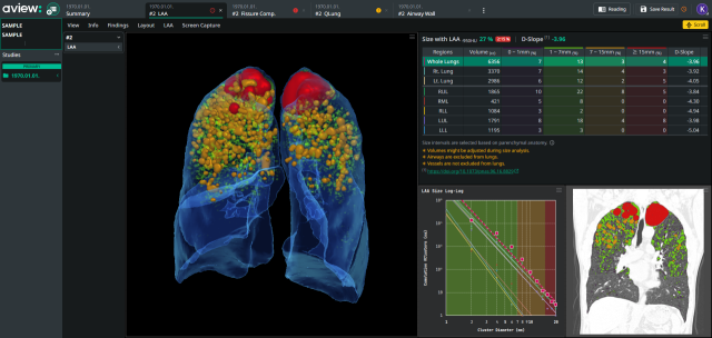코어라인소프트의 ‘에이뷰 씨오피디(AVIEW COPD)’ 화면. 사진 제공=코어라인소프트