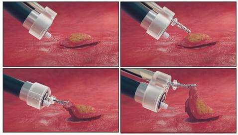 고려대 안암병원 연구진이 개발한 초소형 로봇 내시경 기기가 암 병변을 제거하는 모습.(사진=고려대학교 안암병원)