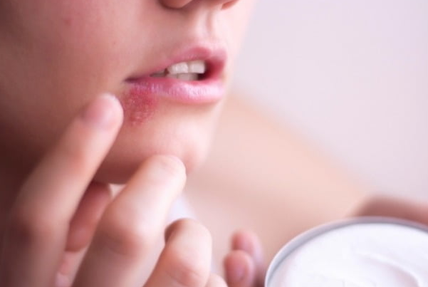 중국의 한 20대 여성이 노래방 마이크에 입을 대고 노래를 부른 뒤 입술에 물집이 잡히는 바이러스에 감염됐다. 사진=게티이미지