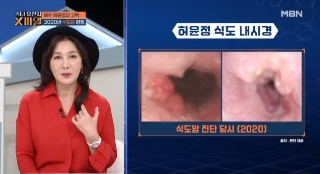 식도암 투병 후 완치 판정을 앞두고 있다고 밝힌 허윤정. 사진 ㅣMBN