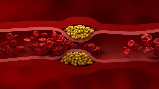 비만을 동반한 이상지질혈증은 혈관 건강 악화로 이어질 수 있다 | 출처: 클립아트코리아