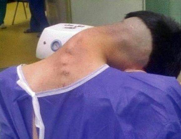 약물 중독으로 머리떨굼증후군(Dropped Head Syndrome, DHS)과 경추후만증(Cervical Kyphoscoliosis, CKS)을 얻은 20대 남성. 이란 이스파한의과대학 신경외과 자료