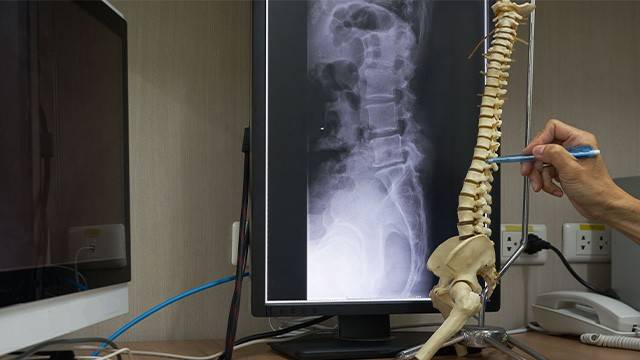 척추 수술은 자신의 상태에 맞게 선택하는 것이 중요하다|출처: 게티이미지뱅크