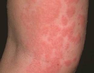 콜린성 두드러기. 서울아산병원