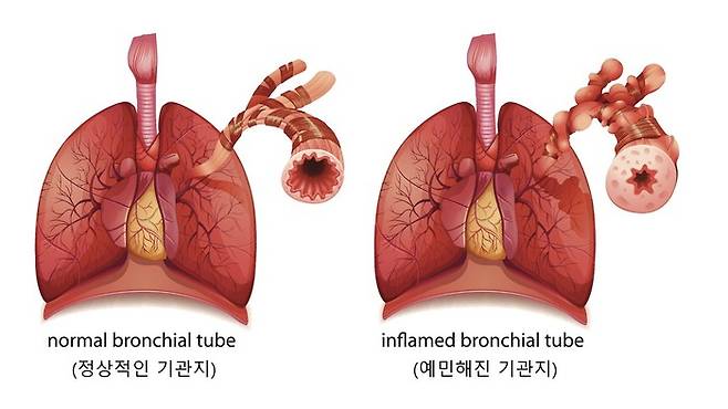 소아 천식 환자의 기관지 비교. 자료 서울대병원