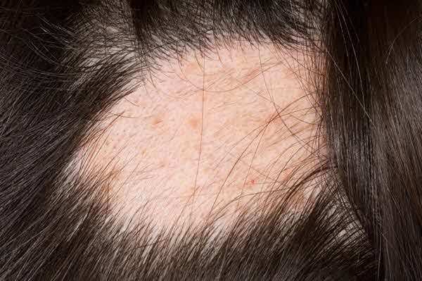 중증 원형탈모 환자들은 상당한 심리적·사회적·경제적 어려움을 겪는다./사진=클립아트코리아