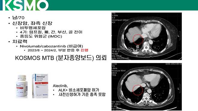 본문 사례 2번(70대 남성 신장암 환자) 허초 제도 적용 치료 예후 개선 영상의학사진. 대한종양내과학회 제공