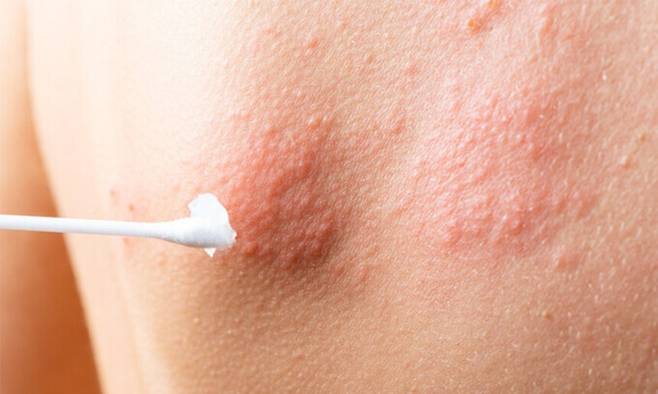 몸통 부위에 띠 모양으로 발생한 대상포진. 빠른 항바이러스제 투여가 필요하다. 국가건강정보포털 제공