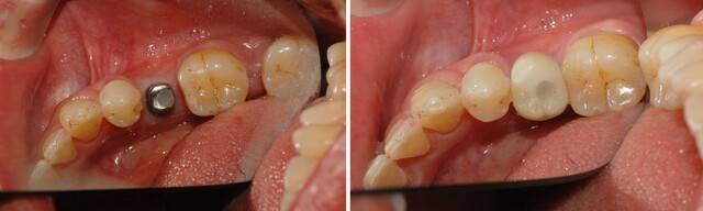 30대 임플란트 수술 전후 이미지 | 출처: 림플란트치과의원