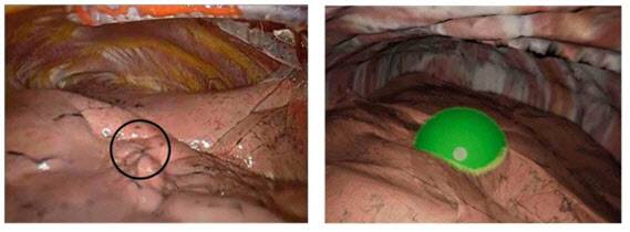 (왼쪽부터) 폐결절 위치를 나타낸 실제 흉강경 영상 및 시뮬레이션 영상 캡처.