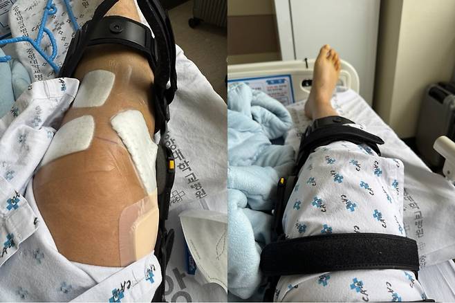 지난 1월 '서부지법 난동' 사태 당시 시위대의 폭행으로 부상당한 이모 경위(34)의 다리. 그는 전방 십자인대와 내외측 인대가 파열돼 무릎에 철심을 박는 수술을 했다./사진=독자 제공