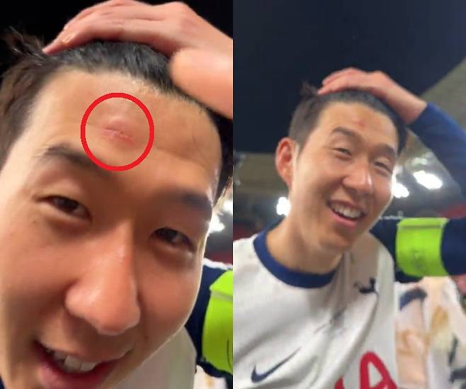 이마의 상처를 보여주는 손흥민의 모습. /사진=토트넘 공식 SNS 영상 갈무리