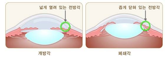 개방각과 폐쇄각 차이. 질병관리청